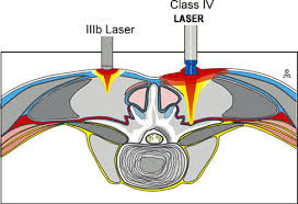laser therapy