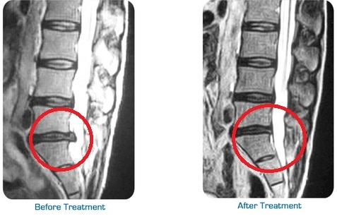 Before and after MRI comparison showing disc retraction following spinal decompression