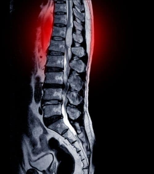 Spinal decompression treatment for spinal stenosis