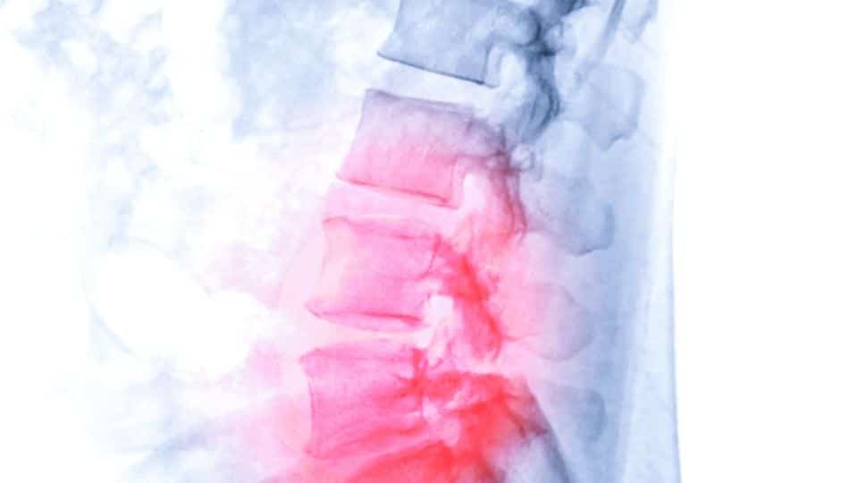 degenerative disc disease