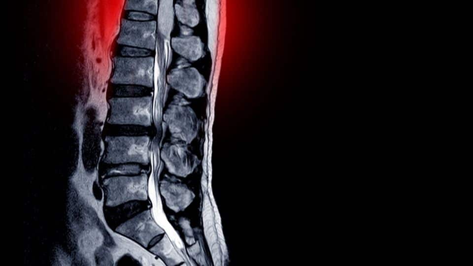 disc bulge