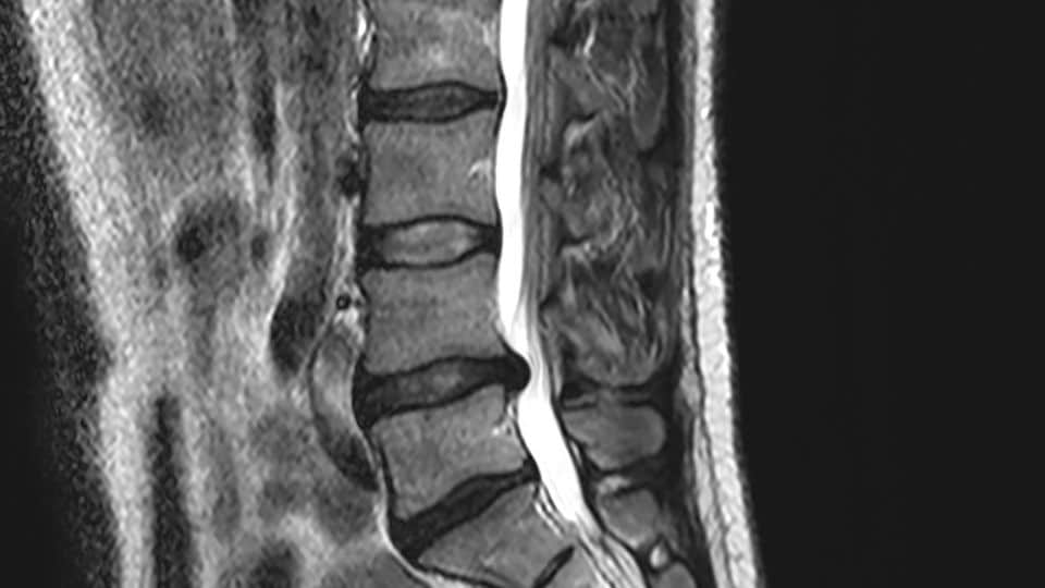 decompression herniated disc