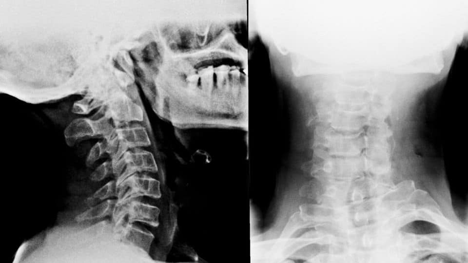 neck spinal decompression