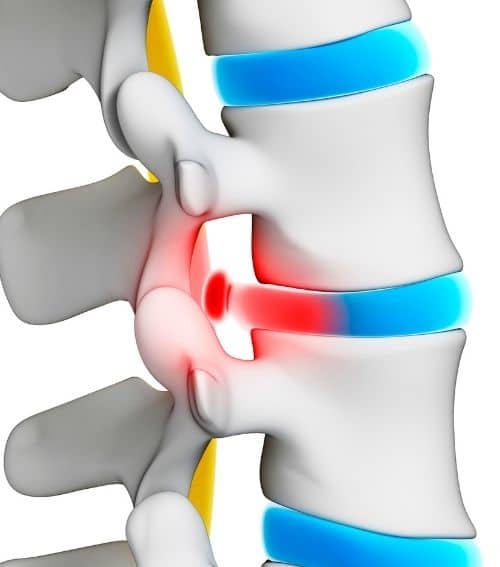 Spinal decompression treatment for a herniated disc