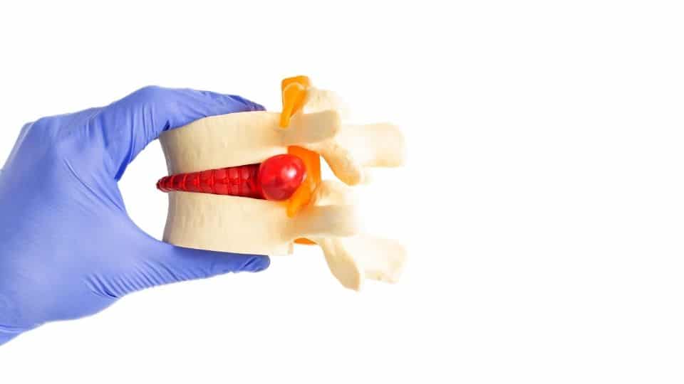 spinal stenosis model