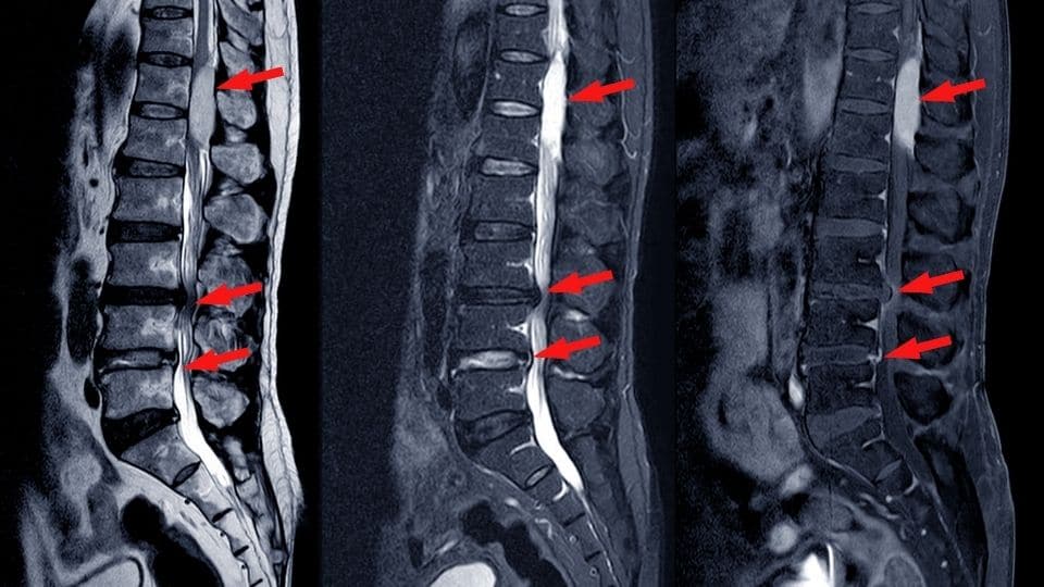 spinal stenosis decompression