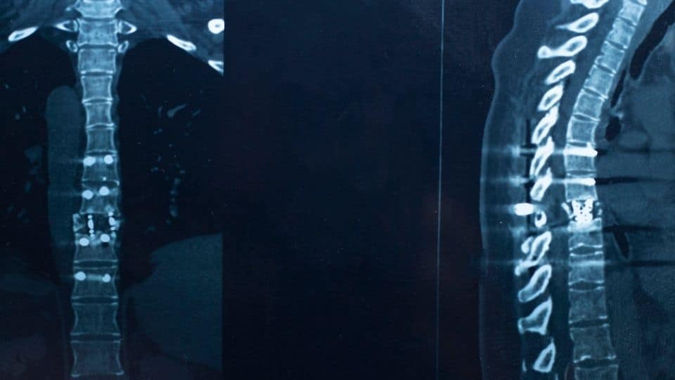 thoracic pain spinal decompression