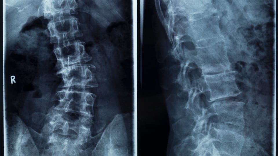 scoliosis23